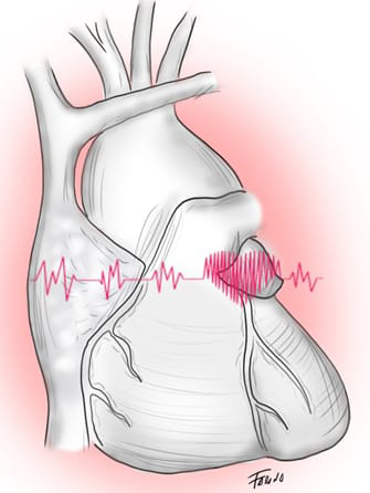 Cuidados de enfermería al paciente cardio-oncológico 