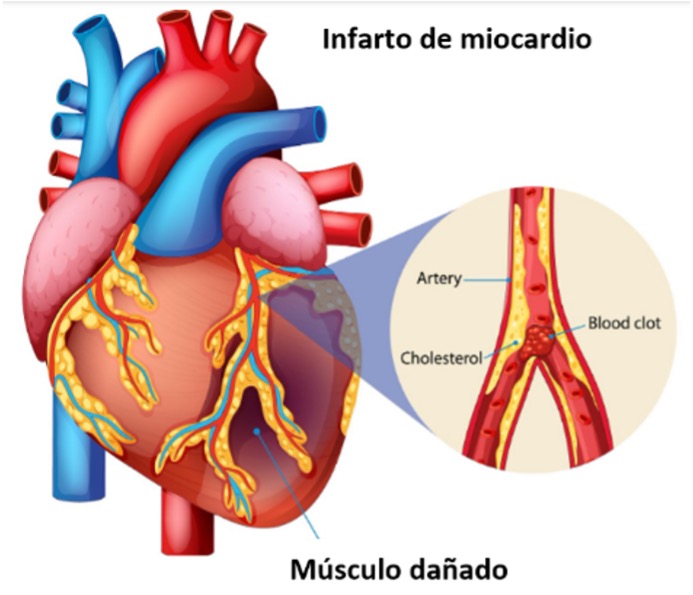 Infarto agudo de miocardio (IAM) - Asociación Española de Enfermería en ...